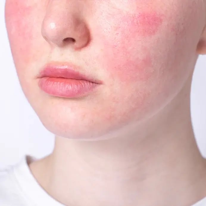 Regionelle - Rosacea - Banner copy