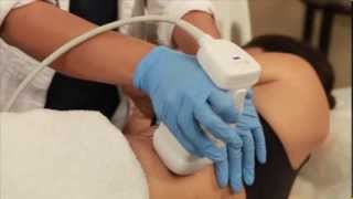Liposonix fat reduction Regional Skin and Laser Center