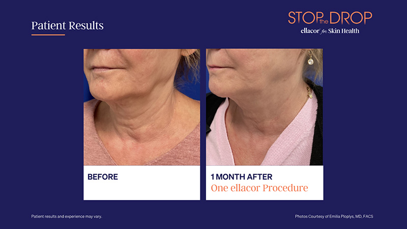 Before and 1 month after one ellacor procedure on the lower face and neck. Photos courtesy of Emilia Ploplys, MD, FACS.